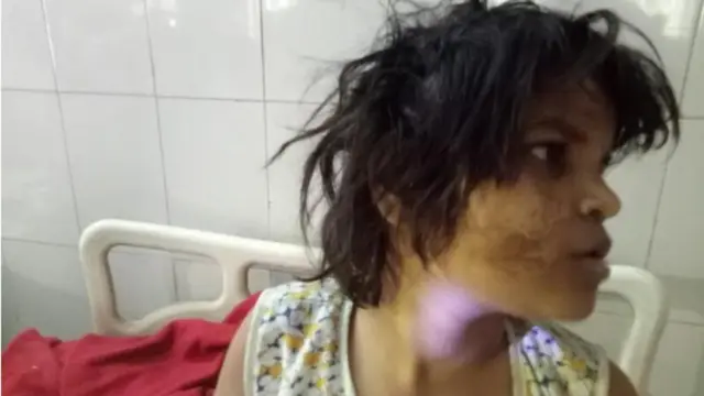 बहराइच के जंगलों में मिली ‘मोगली गर्ल’ एहसास ने 18 साल की उम्र में दुनिया को कहा अलविदा, सेप्टिसीमिया से हुई मौत